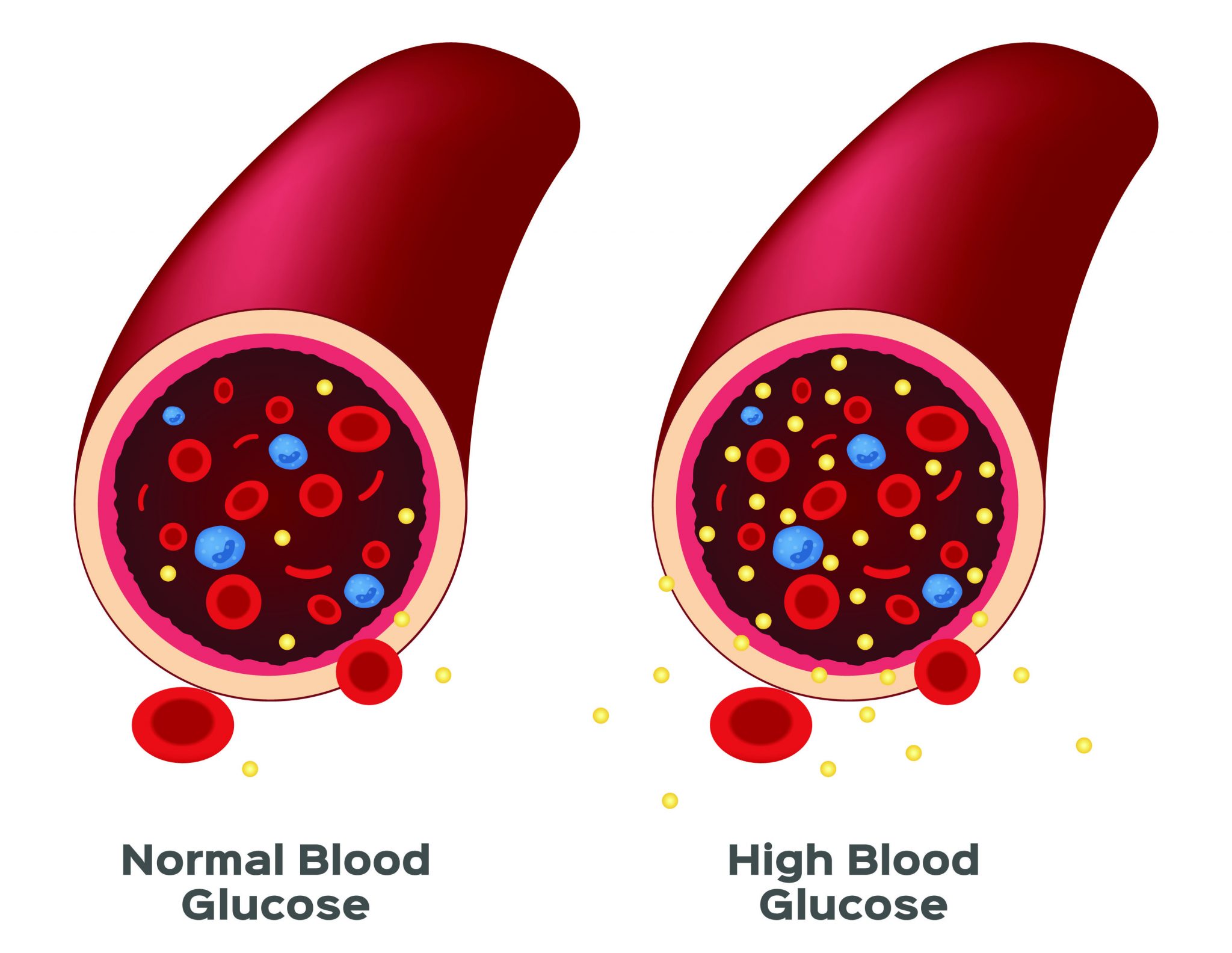 Does High Blood Sugar Cause High Potassium